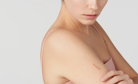 Damaged, irritated skin | BIODERMA