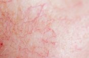 Skin with Redness and Visible Vessels